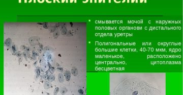 Эпителий плоский в моче 2 4