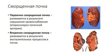 Вторично сморщенная левая почка