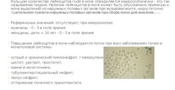 Лейкоциты в моче сплошь у мужчин