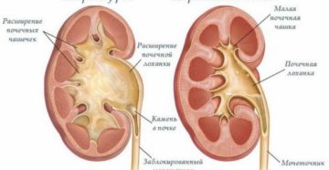 Заболевания лоханки почки